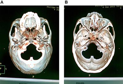 Efficacy and Safety of Repeated Percutaneous Radiofrequency Thermocoagulation for Recurrent Trigeminal Neuralgia